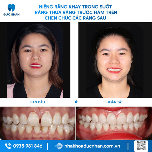 NIỀNG RĂNG TRONG SUỐT