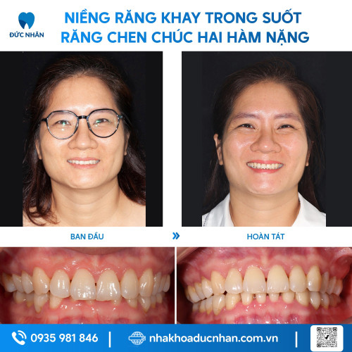 NIỀNG RĂNG TRONG SUỐT