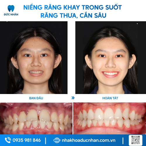 NIỀNG RĂNG TRONG SUỐT