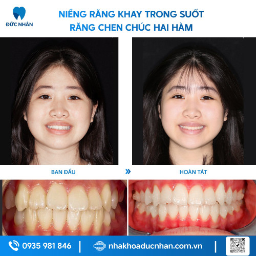 NIỀNG RĂNG TRONG SUỐT