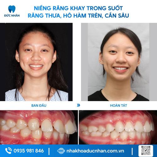 NIỀNG RĂNG TRONG SUỐT