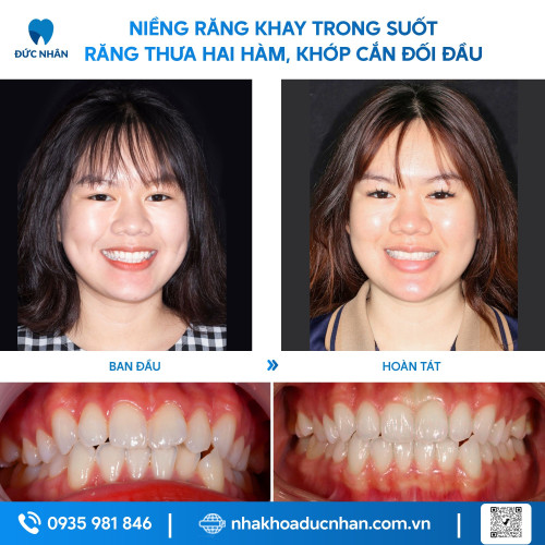 NIỀNG RĂNG TRONG SUỐT