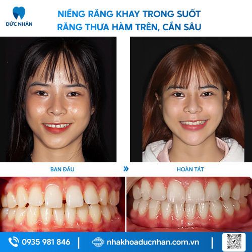 NIỀNG RĂNG TRONG SUỐT