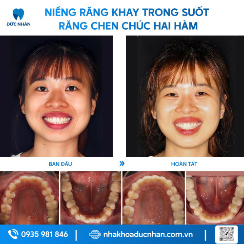 NIỀNG RĂNG TRONG SUỐT