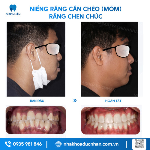 NIỀNG RĂNG MẮC CÀI