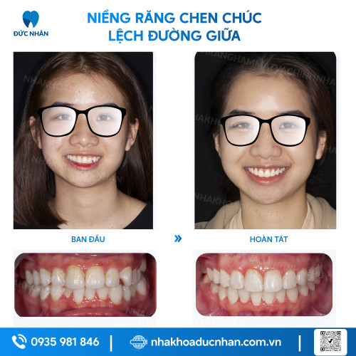 NIỀNG RĂNG MẮC CÀI