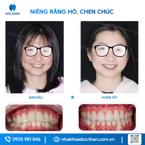 NIỀNG RĂNG MẮC CÀI