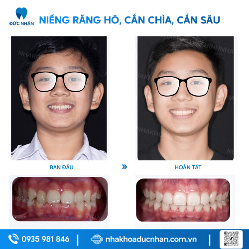 NIỀNG RĂNG MẮC CÀI