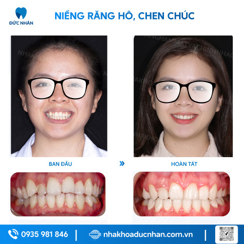 NIỀNG RĂNG MẮC CÀI