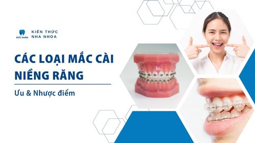 Các loại mắc cài niềng răng nào phổ biến? Ưu và nhược điểm