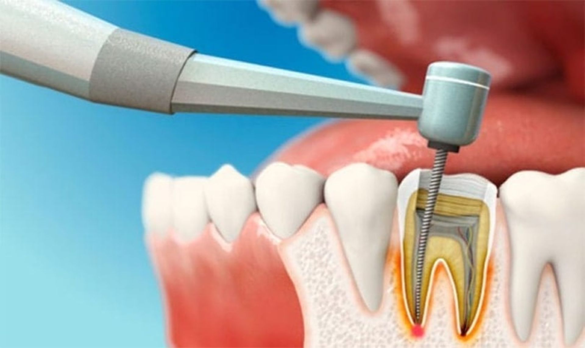 Điều trị tủy răng không đau nhờ Bác sĩ chuyên môn giỏi, công nghệ hiện đại