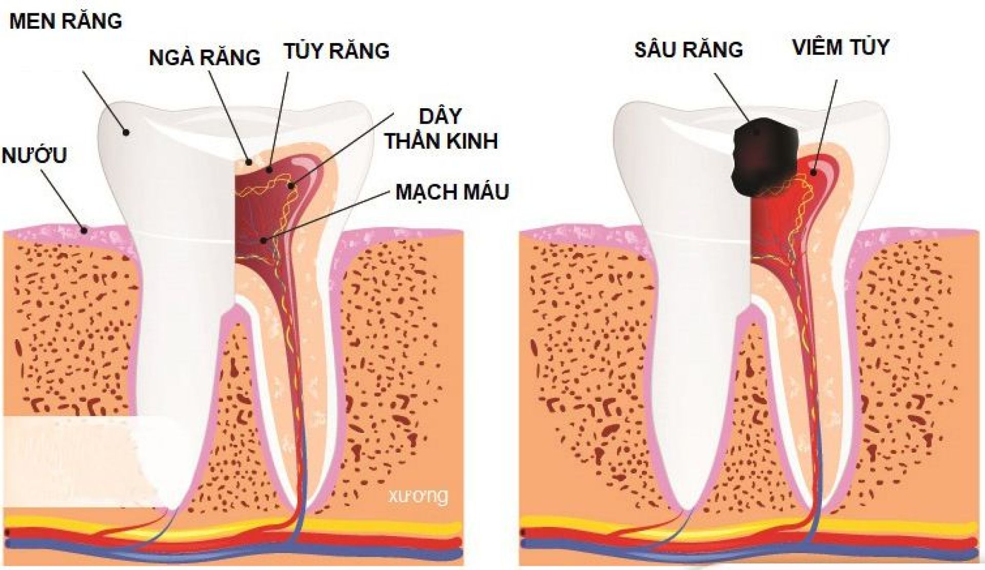 Điều trị tủy răng (nội nha) là việc loại bỏ mô tủy đã bị viêm nhiễm do vi khuẩn xâm nhập