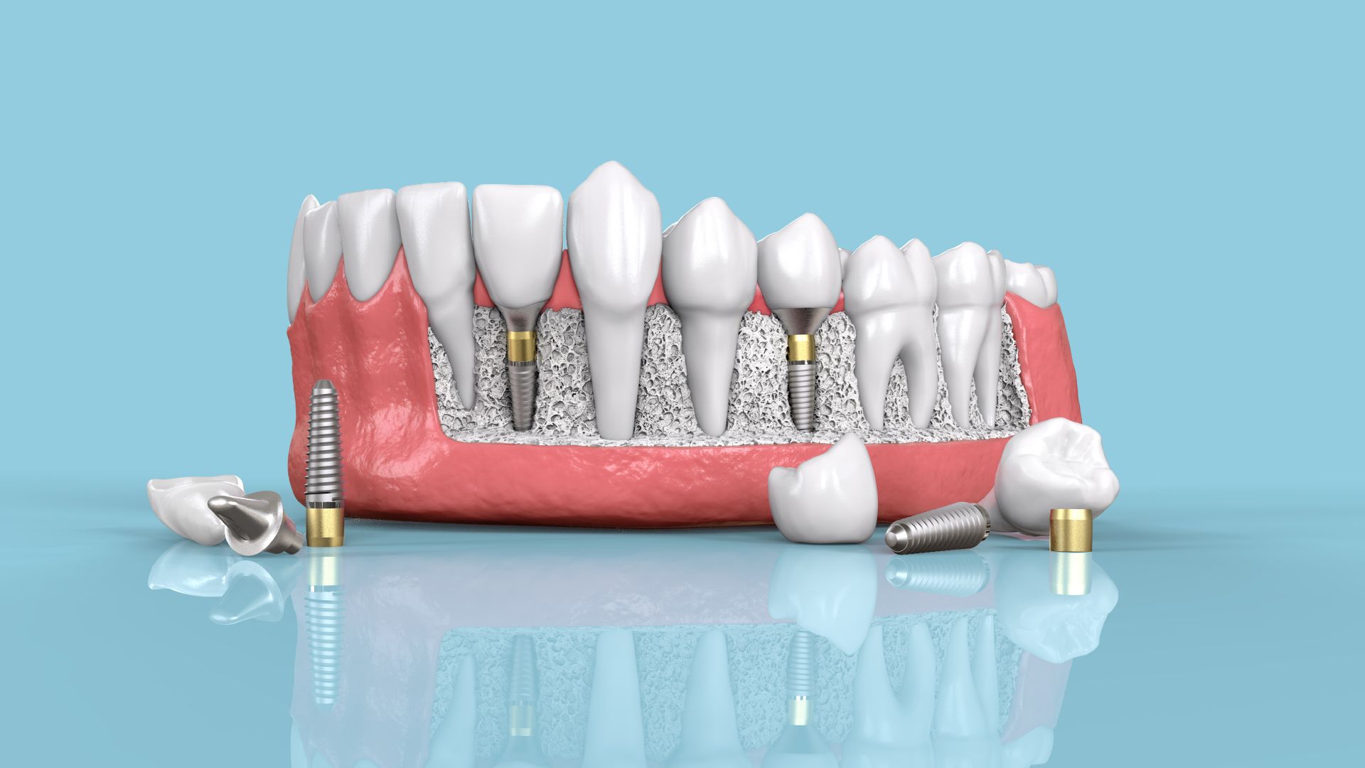 Trồng răng Implant là gì?