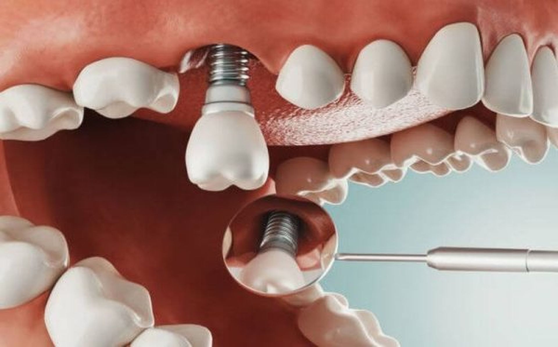 vì sao có nơi lại trồng Implant giá rẻ?