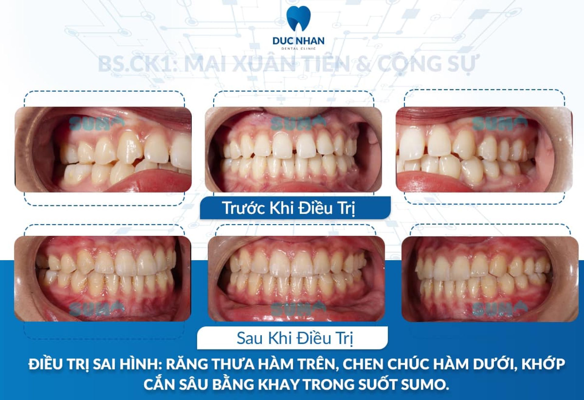 Tìm hiểu phương pháp niềng răng phù hợp trước khi niềng răng