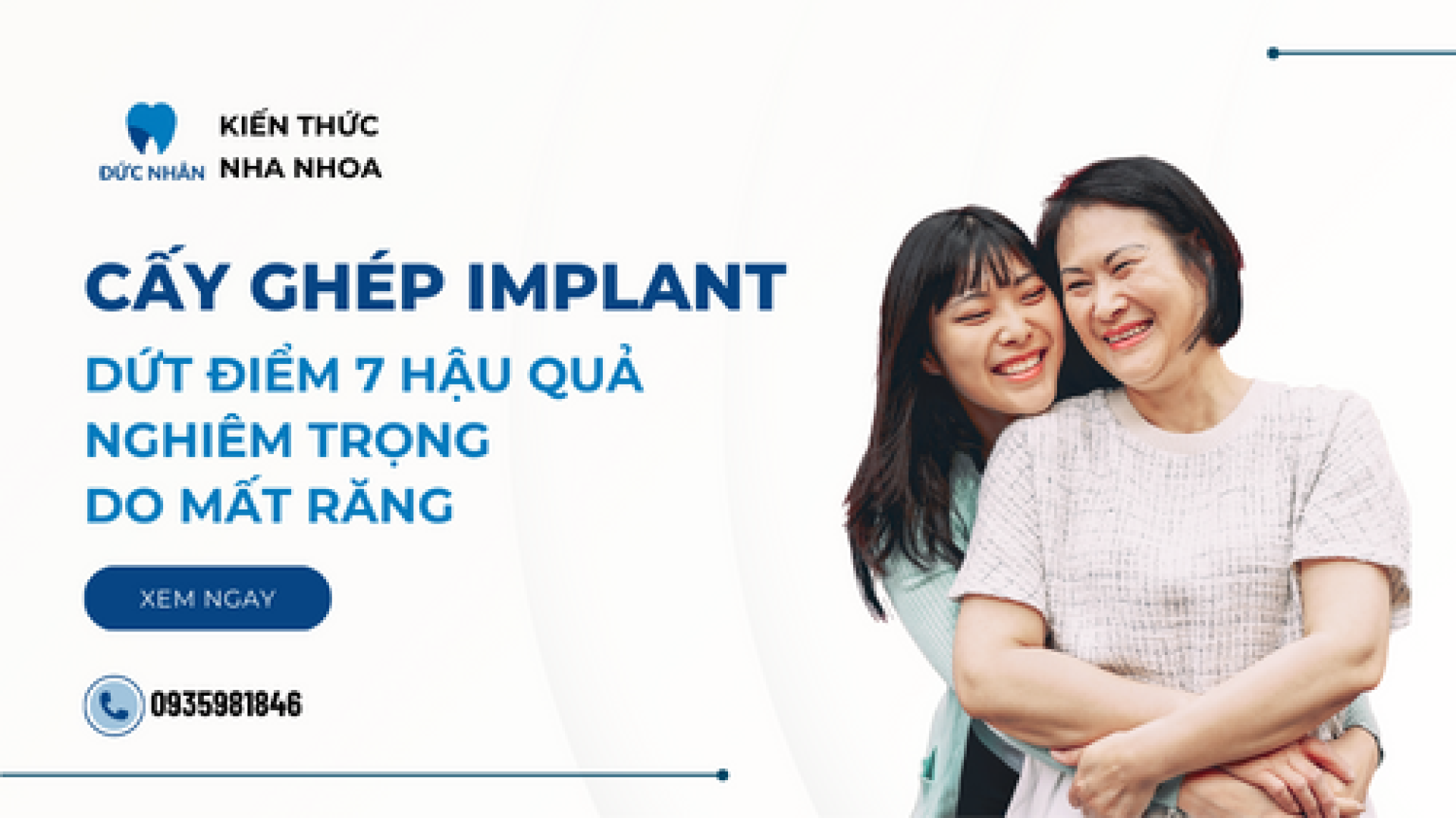 Cấy ghép Implant - Dứt điểm 7 hậu quả nghiêm trọng do mất răng