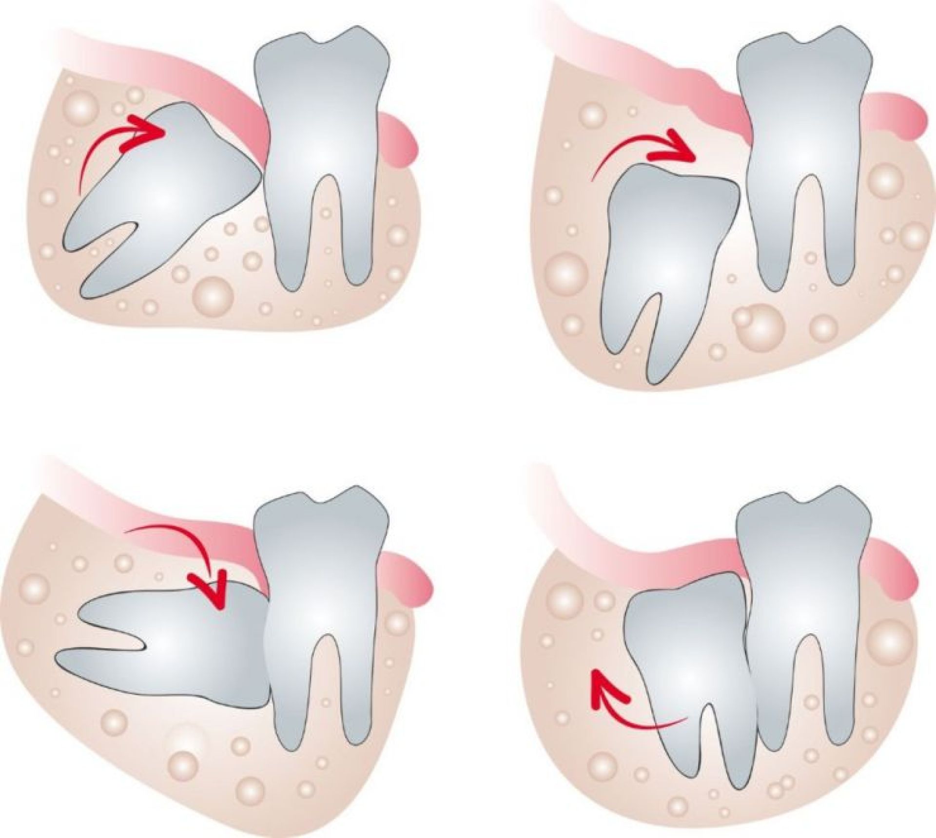 Những trường hợp được khuyến cáo nhổ răng khôn càng sớm càng tốt