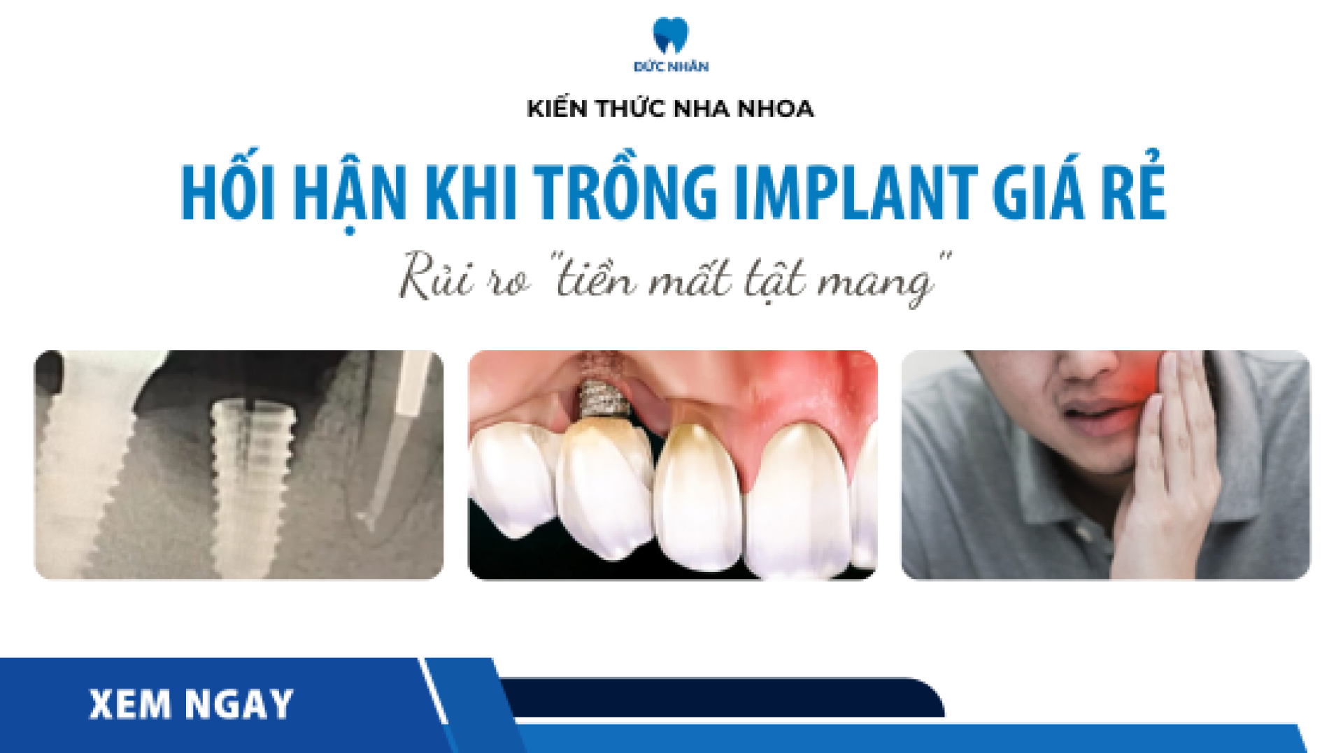 Hối hận khi trồng Implant giá rẻ 