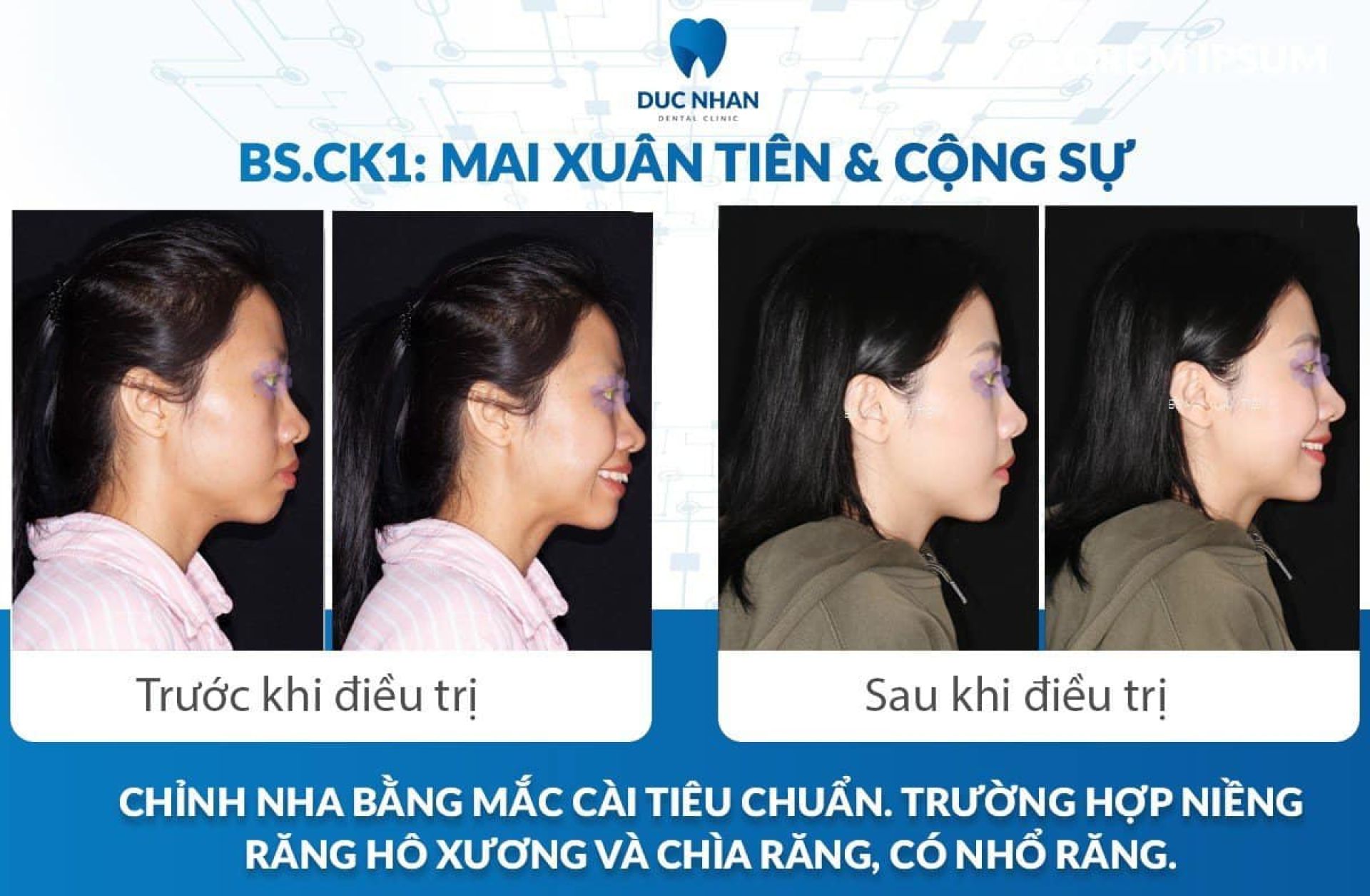 Trước và sau khi niềng răng hô xương và chìa răng bằng mắc cài tiêu chuẩn