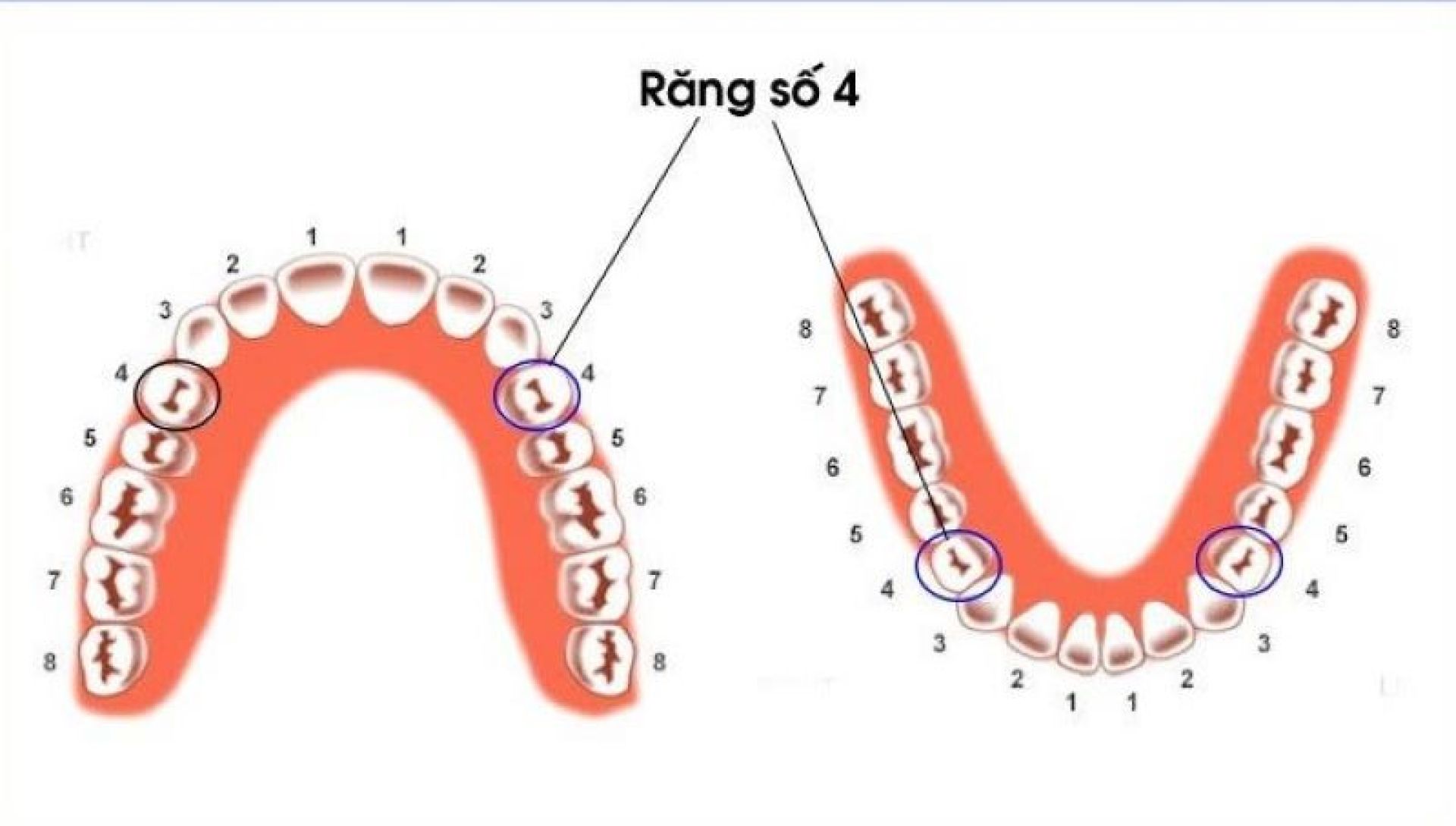 Răng số 4 là gì, có nên nhổ răng số 4 khi niềng không