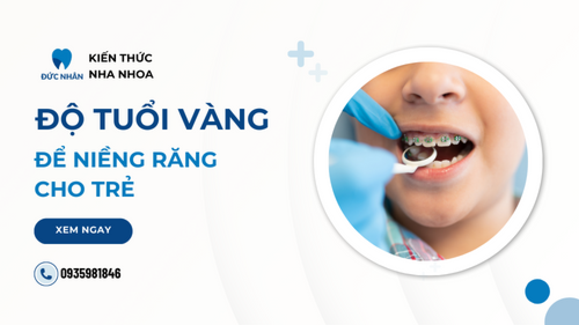 Niềng răng trẻ em và độ tuổi "vàng" để niềng răng cho bé