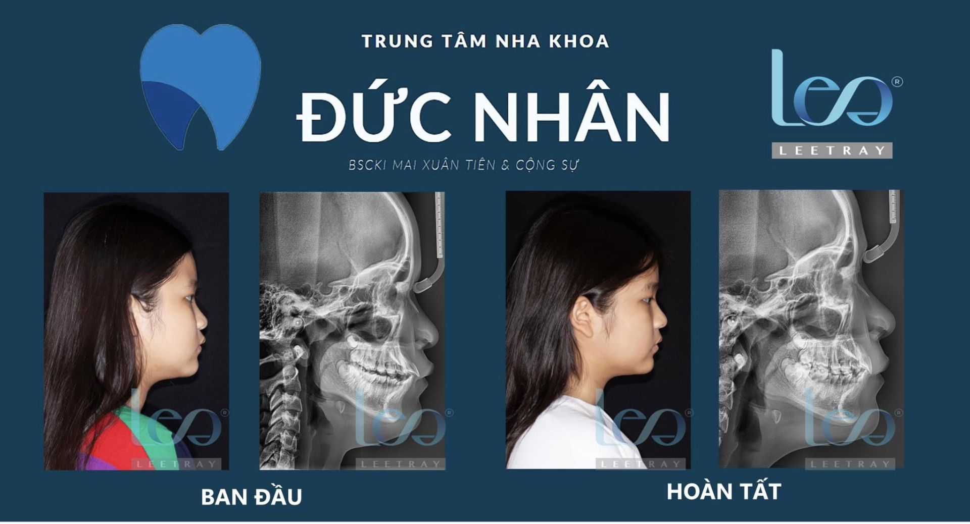 Niềng răng sớm cho trẻ giúp mang lại hiệu quả niềng nhanh chóng và tốt hơn