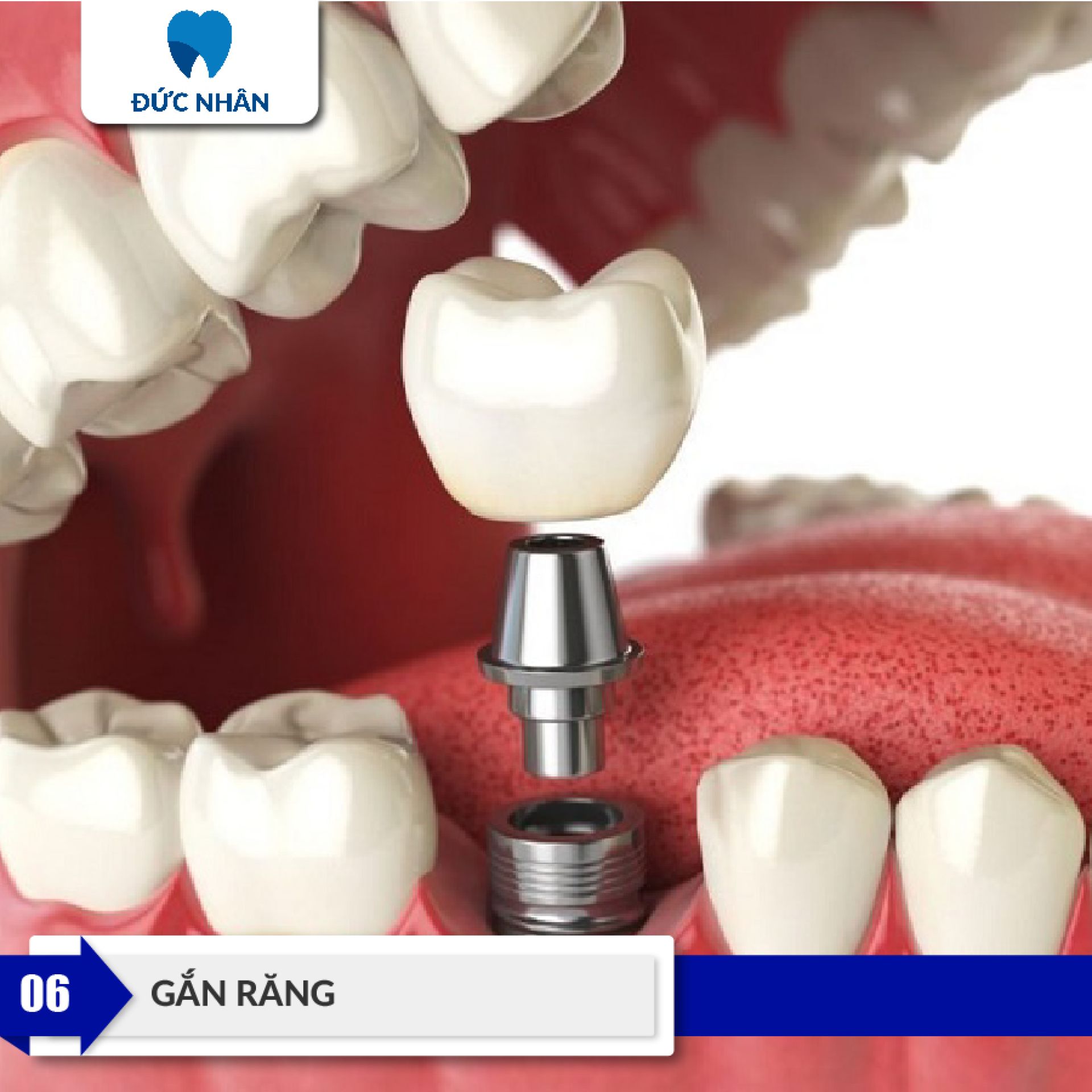 Bác sĩ sẽ phục hình sứ lên trên trụ Implant