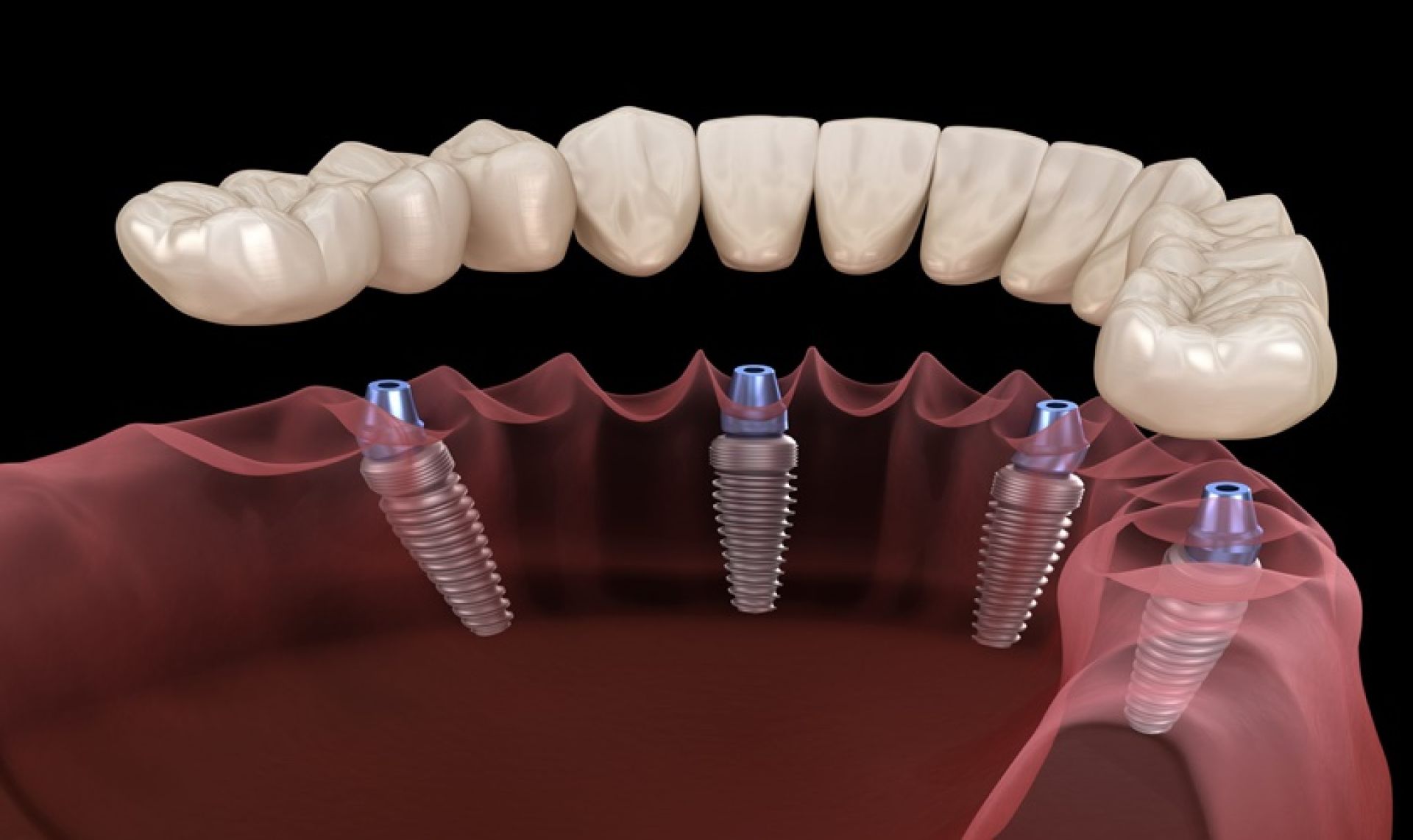 Trồng răng Implant có đau không dựa vào mức độ phức tạp của ca điều trị