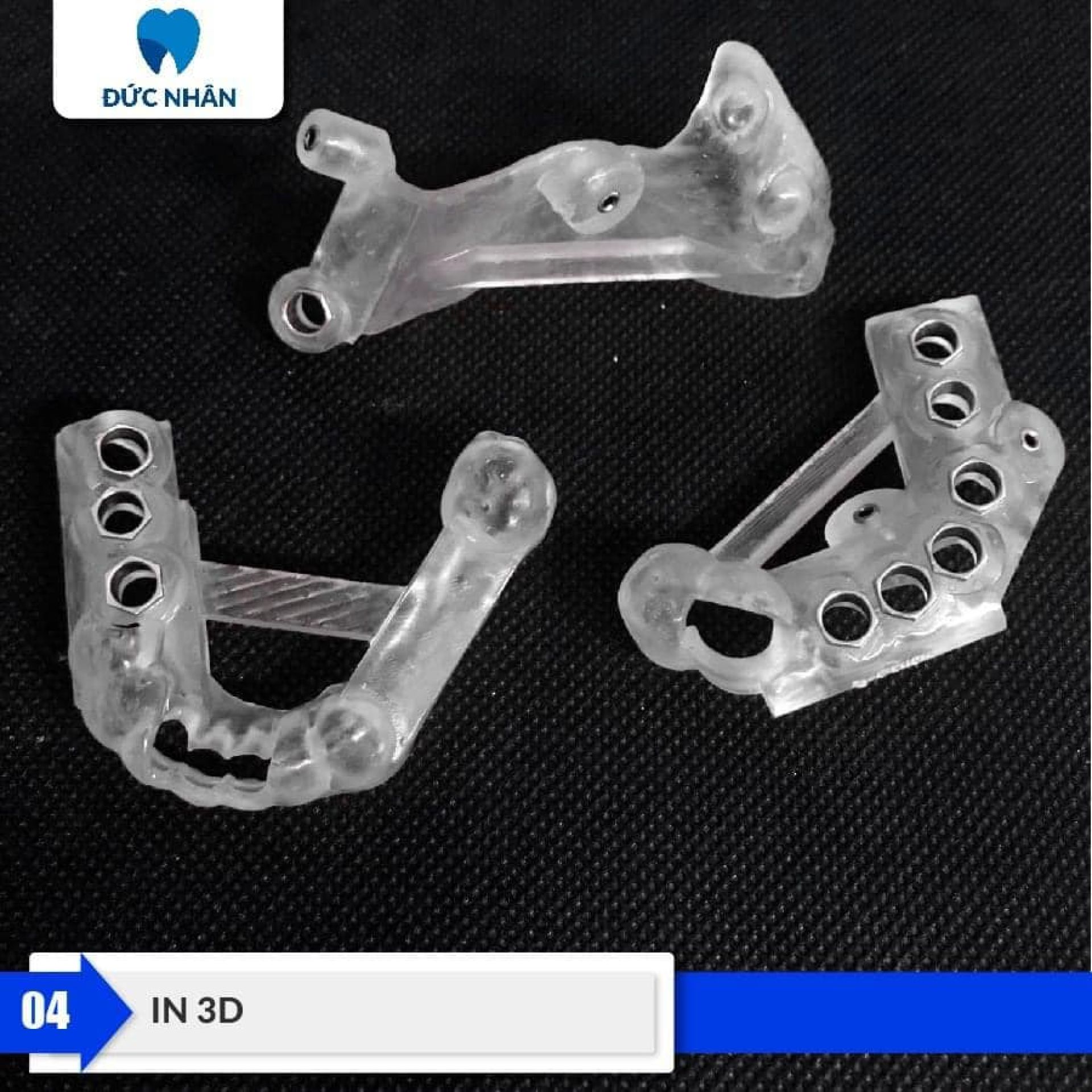 Quy trình trồng răng Implant - In máng phẫu thuật 3D