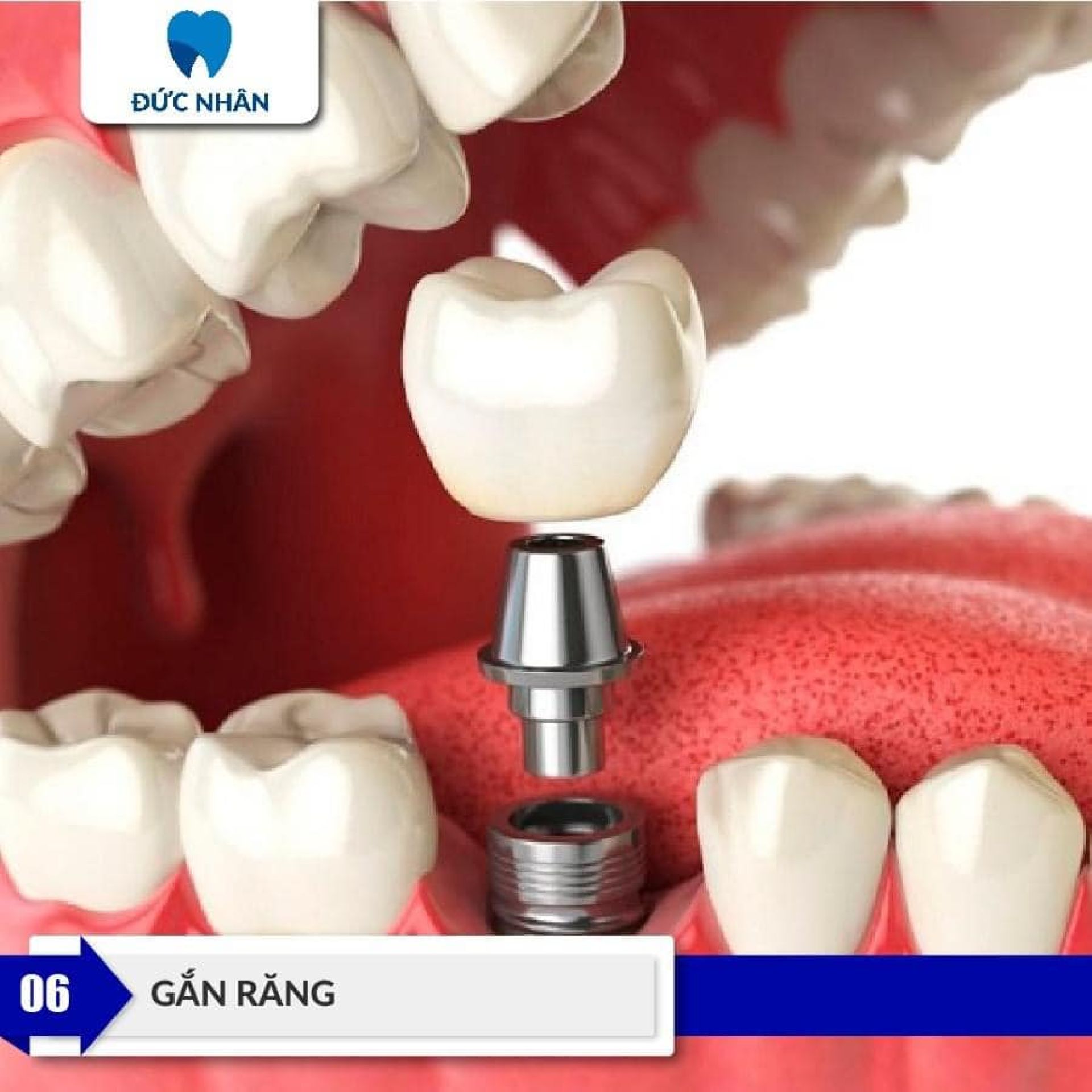 Phục hình sứ và hoàn thiện Implant