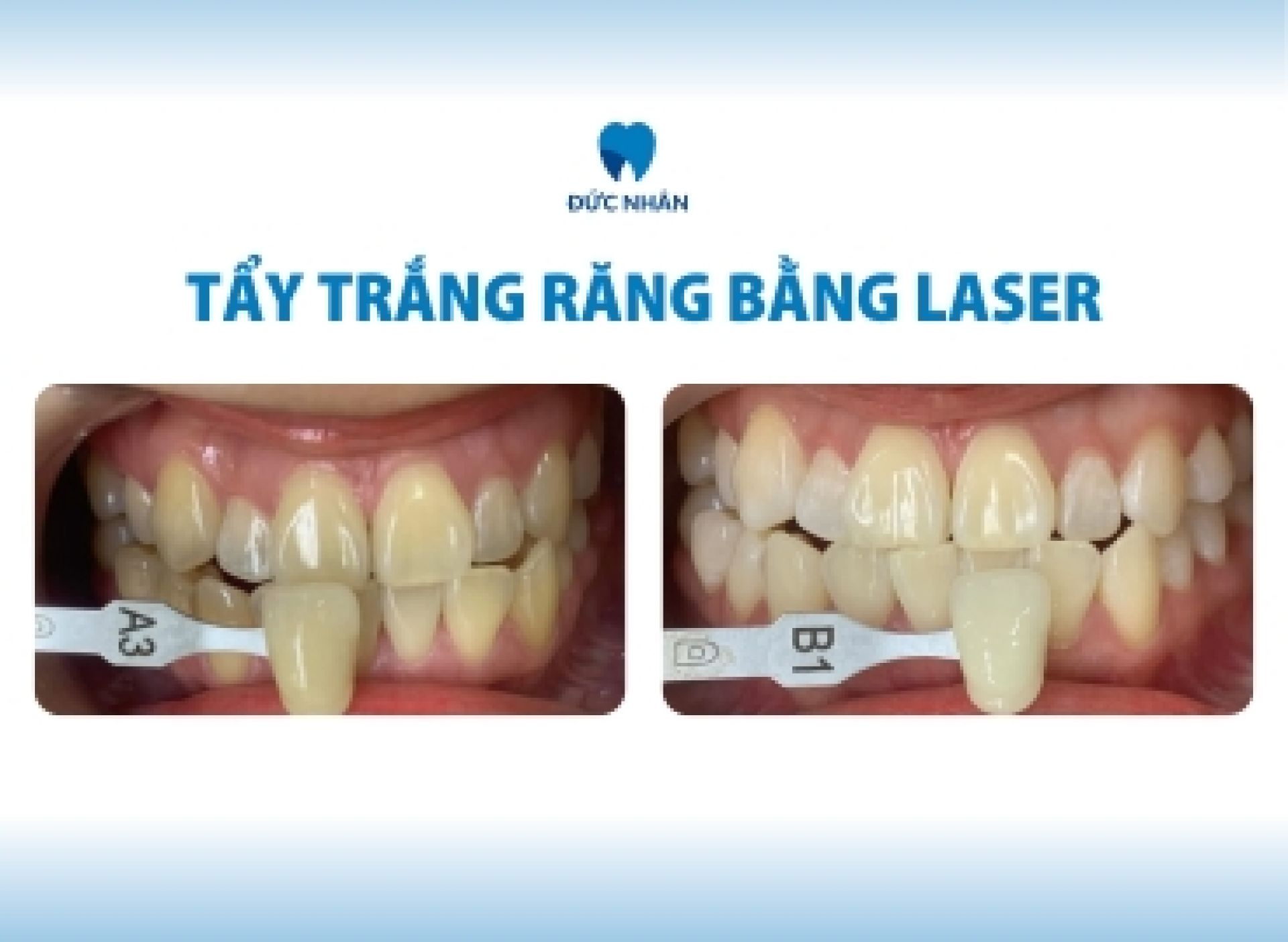 Tẩy trắng răng có bị vàng lại không - Tẩy trắng răng bằng công nghệ laser và Plasma có độ bền tối thiểu 3 năm