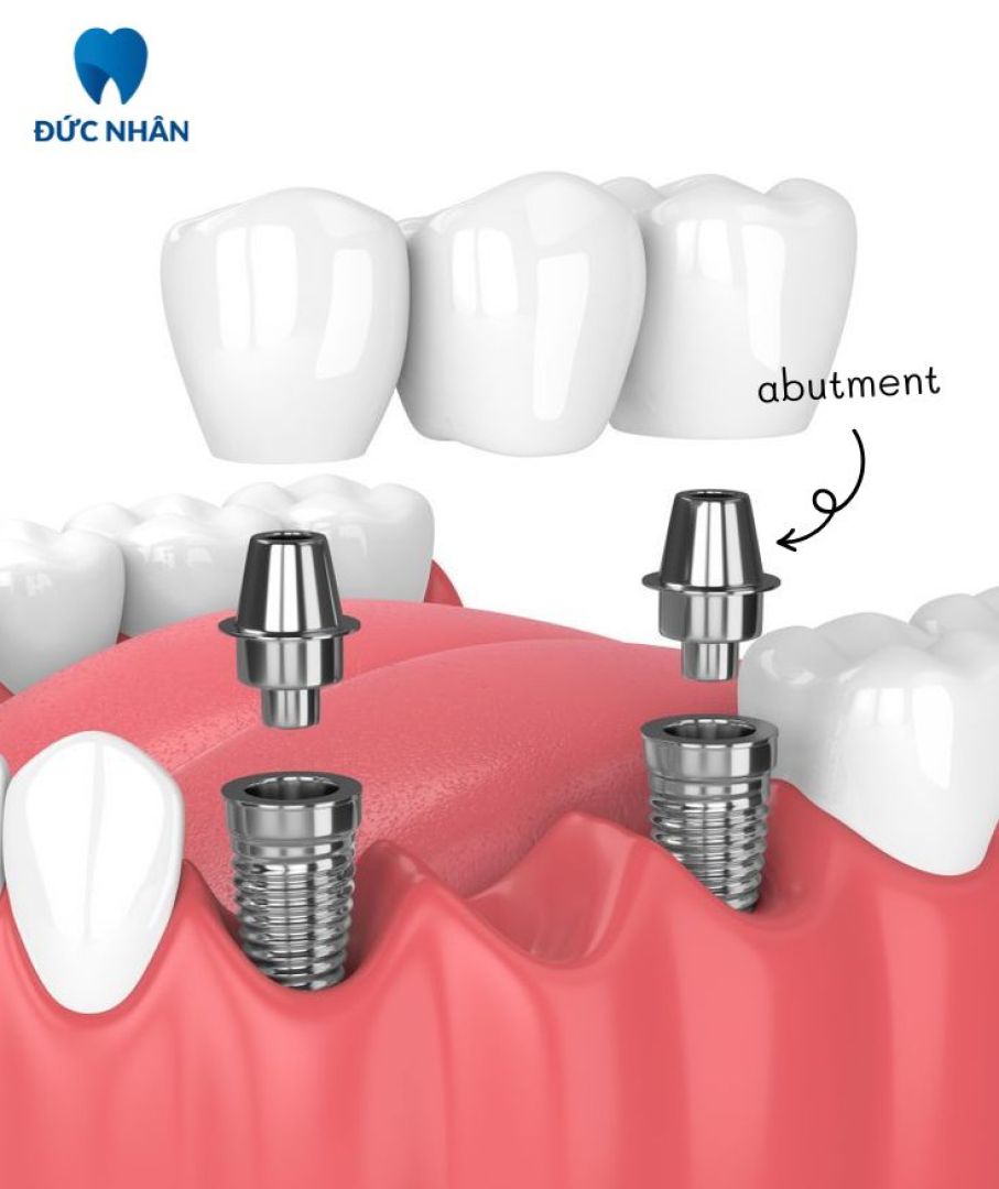 cấy ghép implant răng sứ