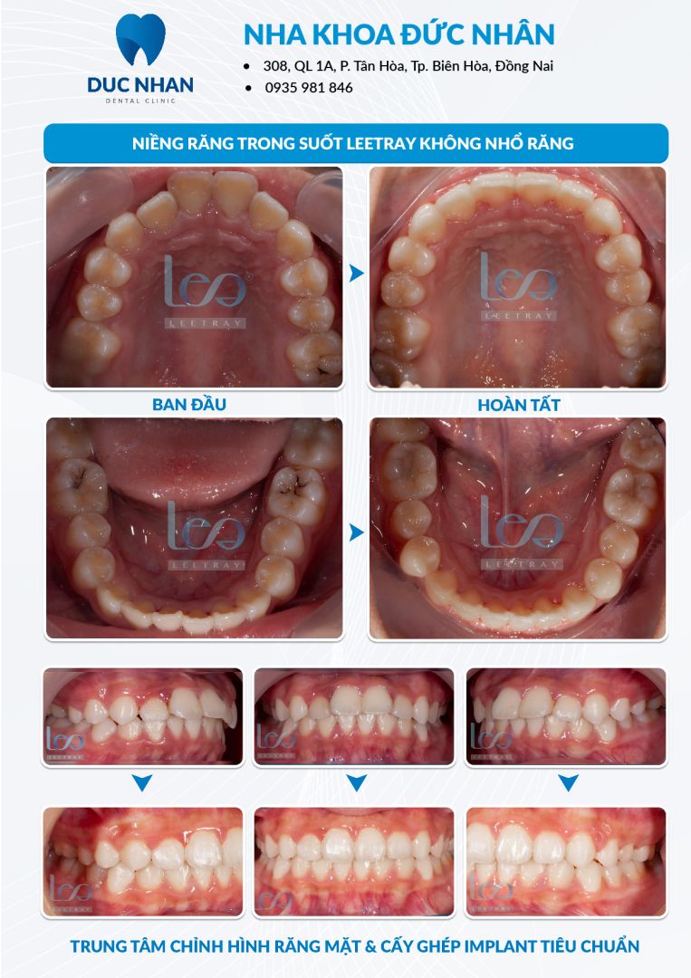 Những trường hợp nào nên niềng răng trong suốt - Nha khoa Đức Nhân Biên Hòa