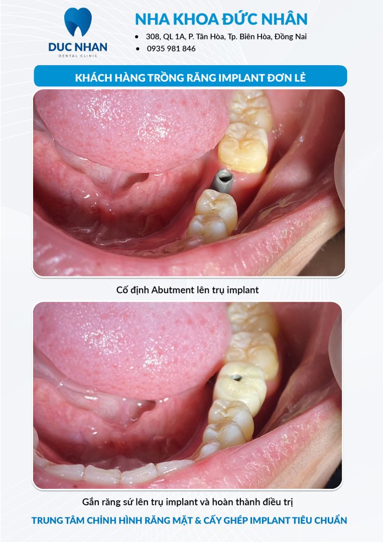 Trồng răng Implant đơn lẻ biên hòa - Nha khoa Đức Nhân