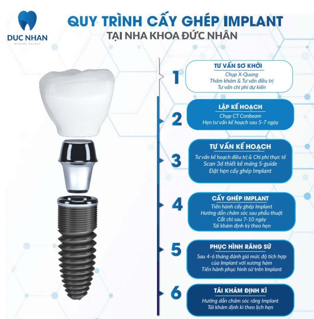 Quy trình trồng răng Implant tại Nha khoa Đức Nhân