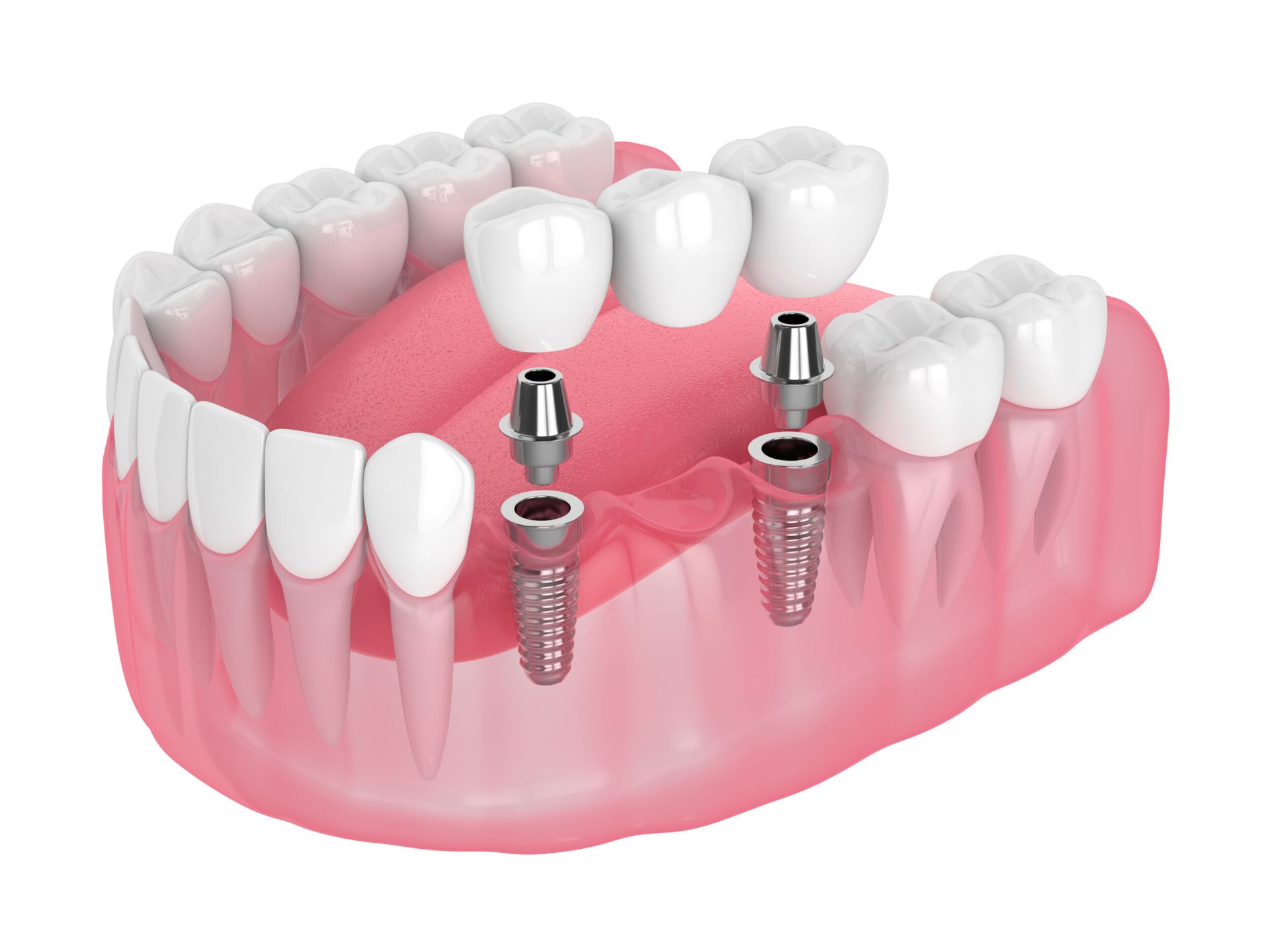 Cầu răng sứ trên Implant