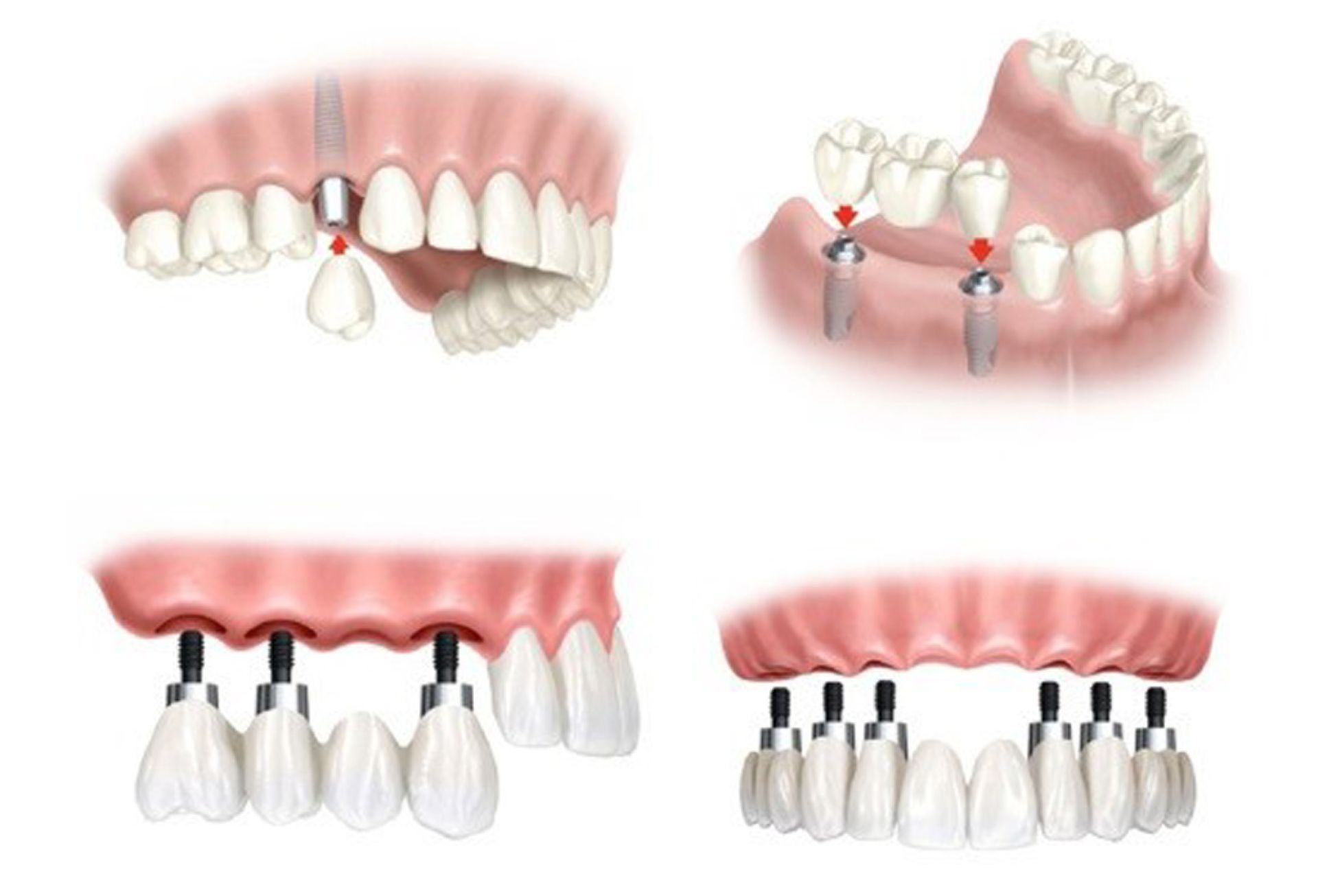 Những trường hợp nên trồng răng Implant