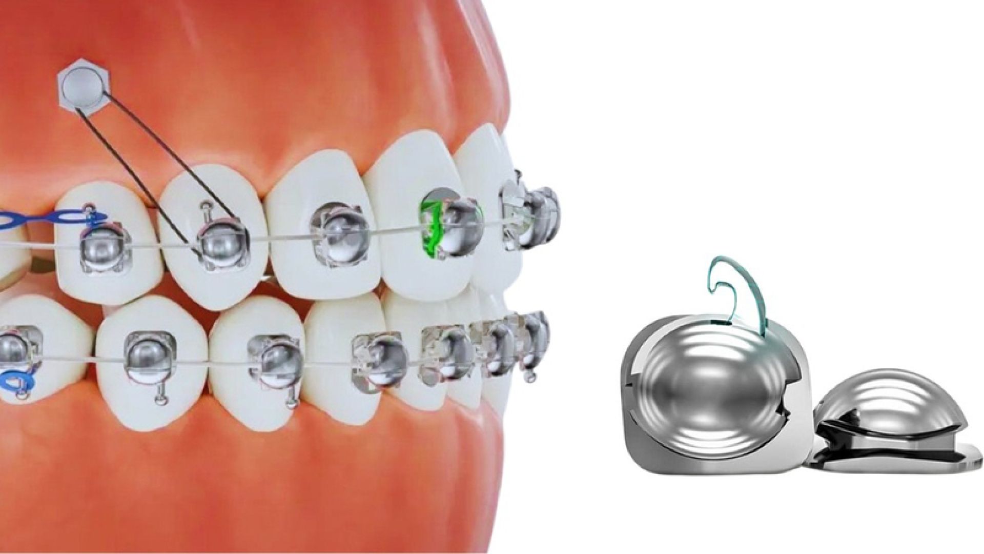 ưu nhược điểm mắc cài cánh cam