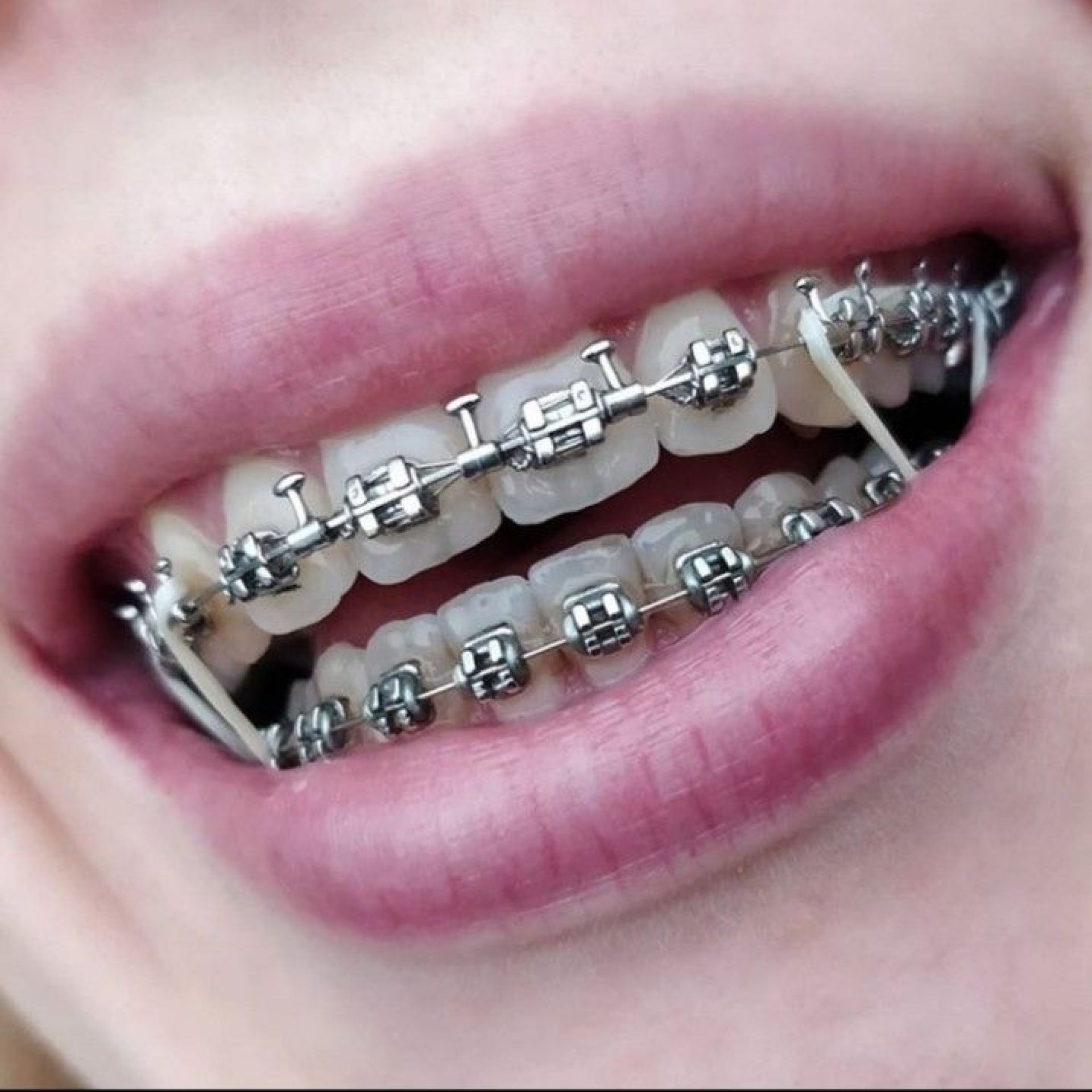 mắc cài tự đóng