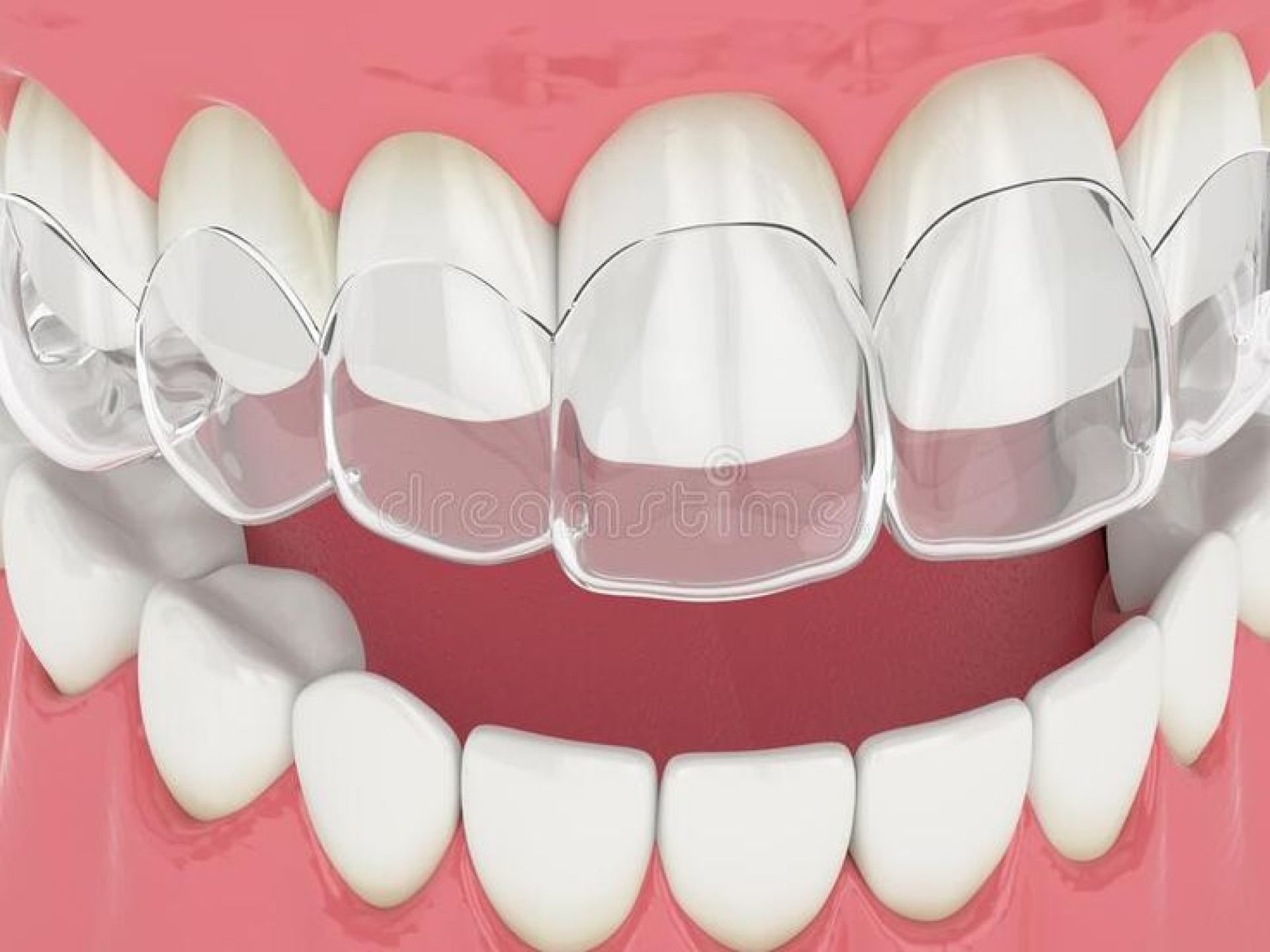 niềng răng trong suốt