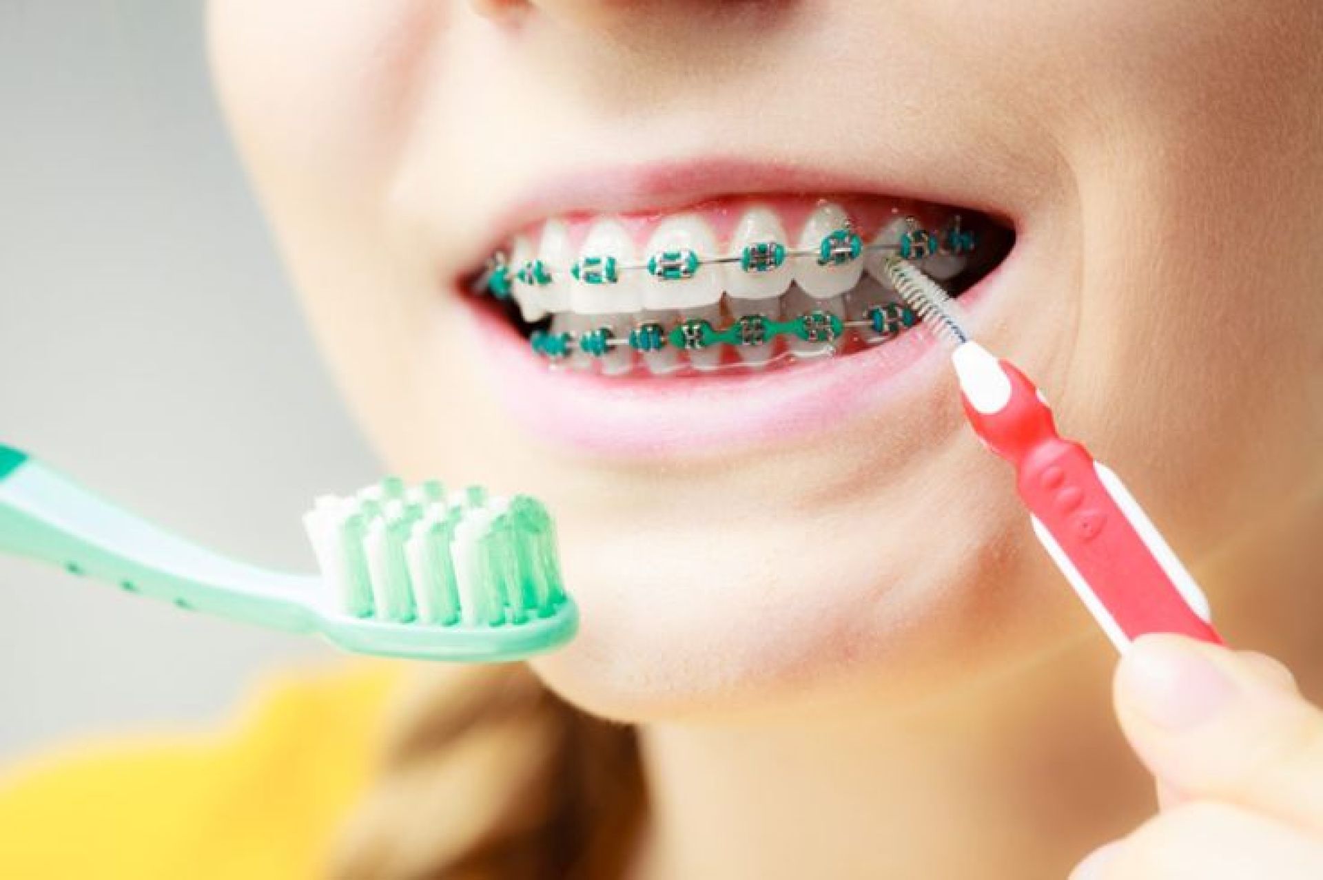 vệ sinh răng miệng cho người mới niềng răng