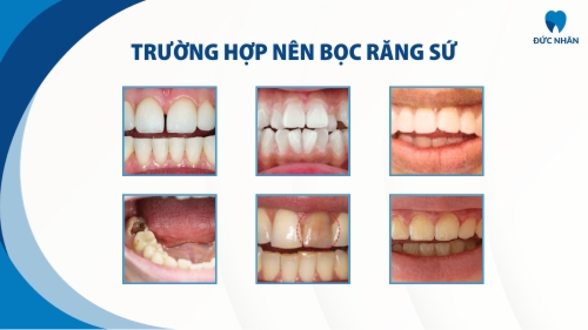 Những trường hợp nên bọc răng sứ càng sớm càng tốt