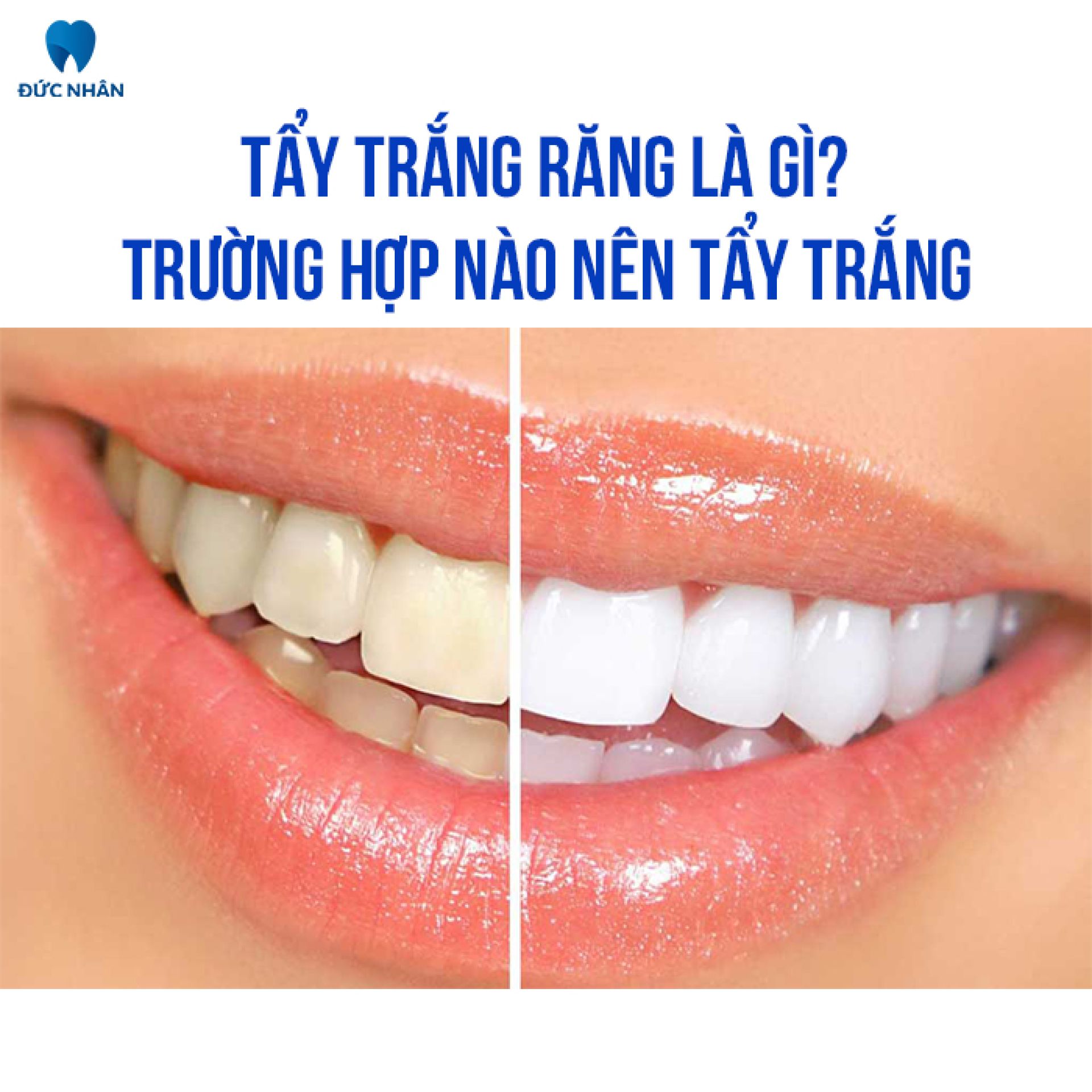 Tẩy trắng răng là gì và trường hợp nào nên tẩy răng - Nha khoa Đức Nhân Biên Hòa