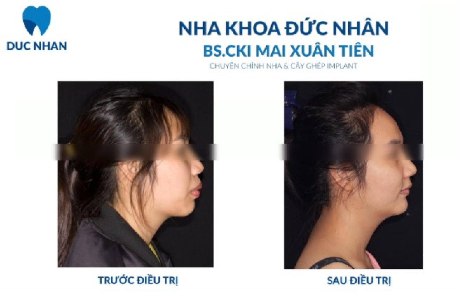 Khuôn mặt trước và sau khi niềng răng khấp khểnh