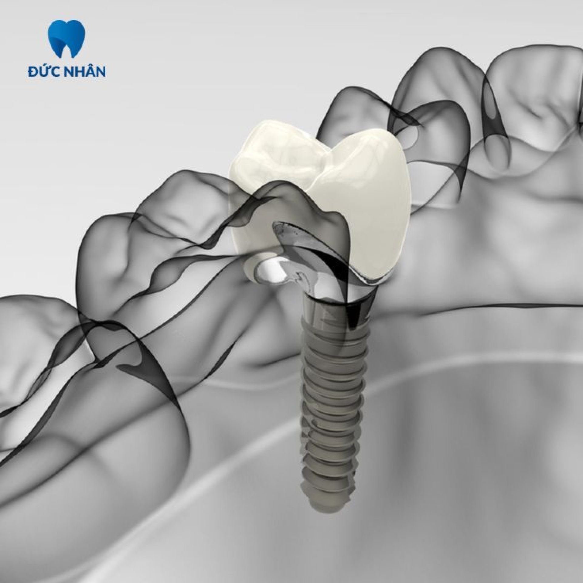 mão sứ implant