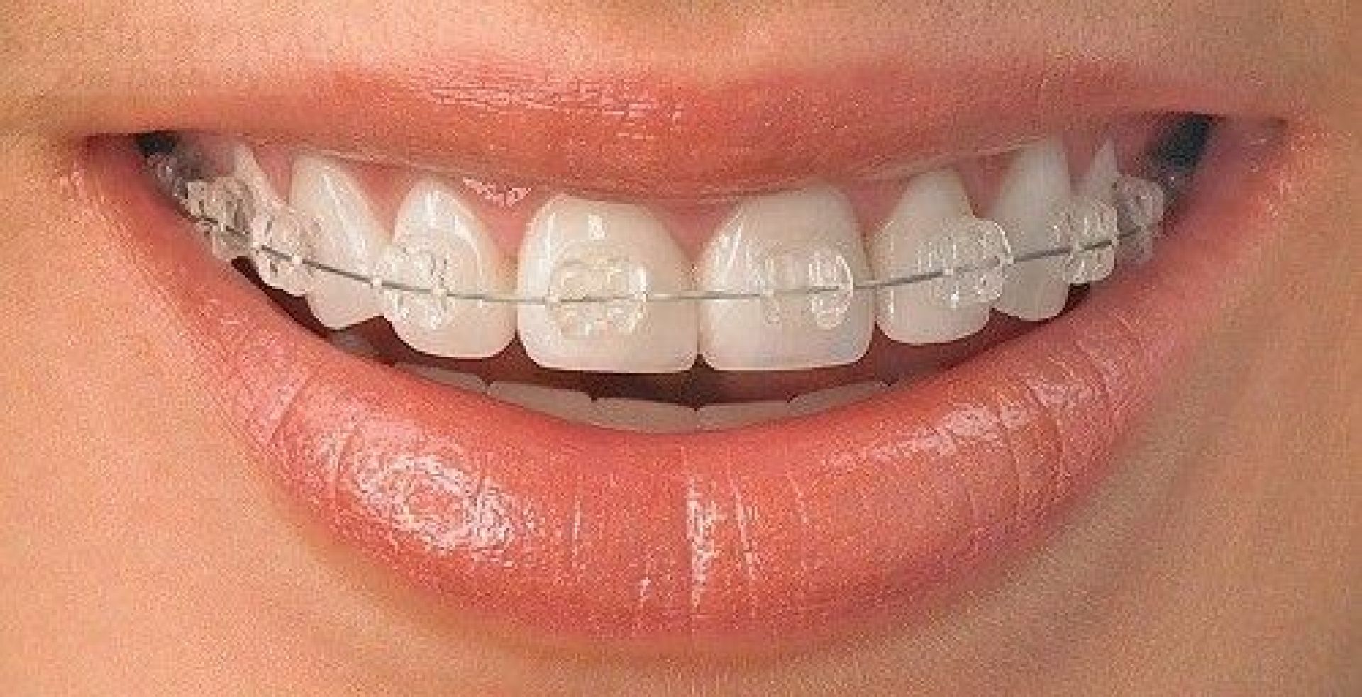 mắc cài sứ