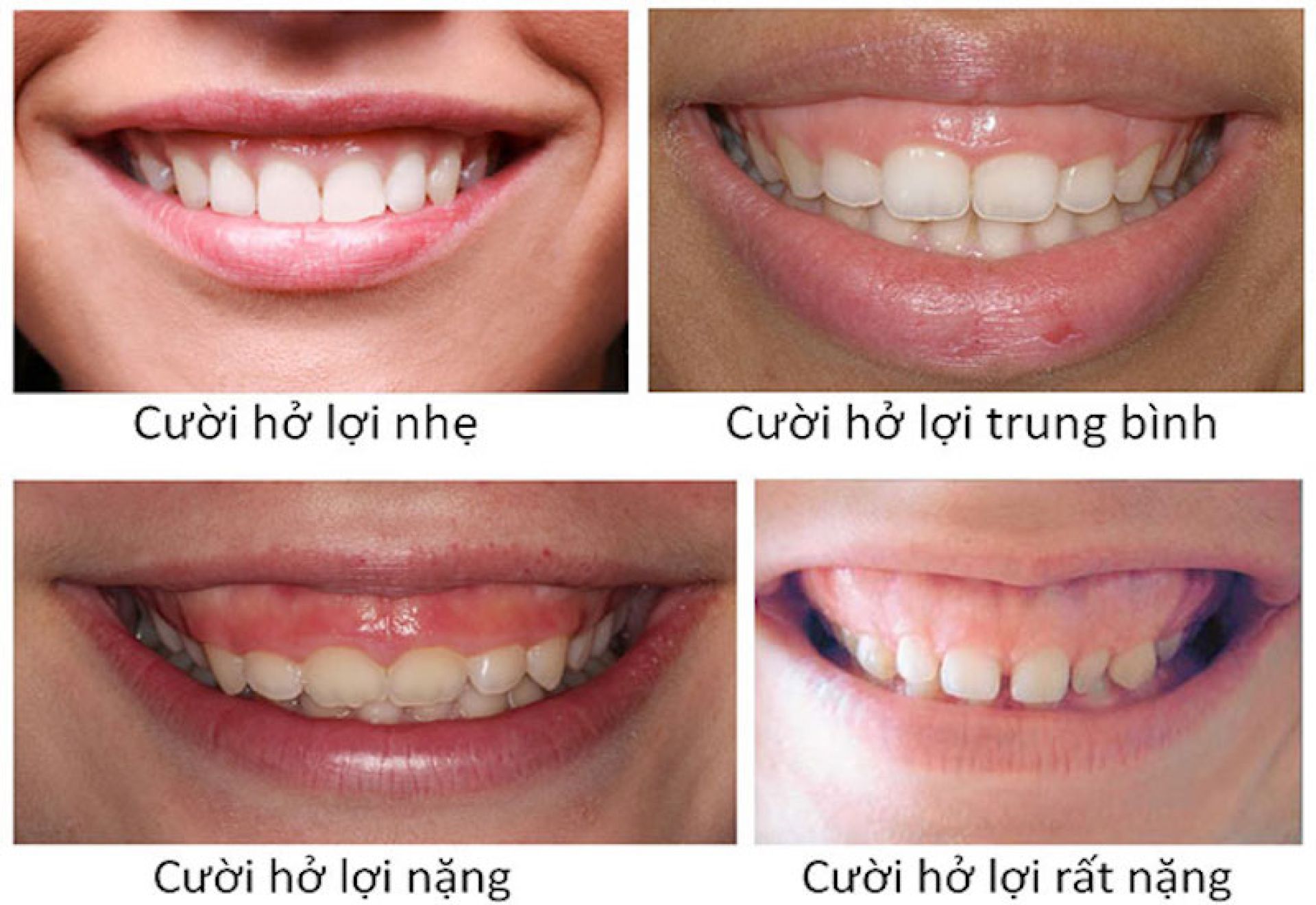 Cách xác định mức độ cười hở lợi tương đối