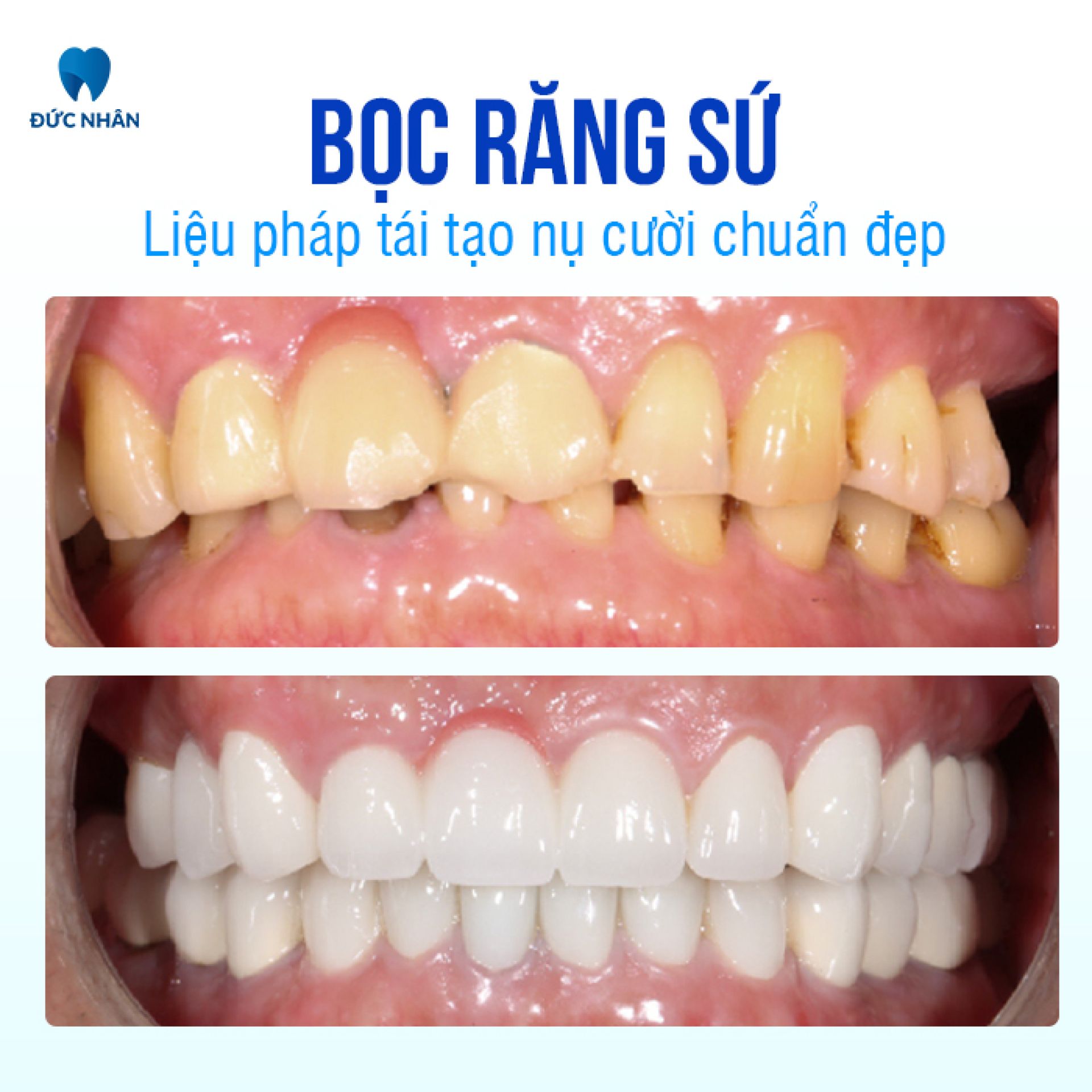 Bọc răng sứ - Liệu pháp tái tạo nụ cười chuẩn đẹp