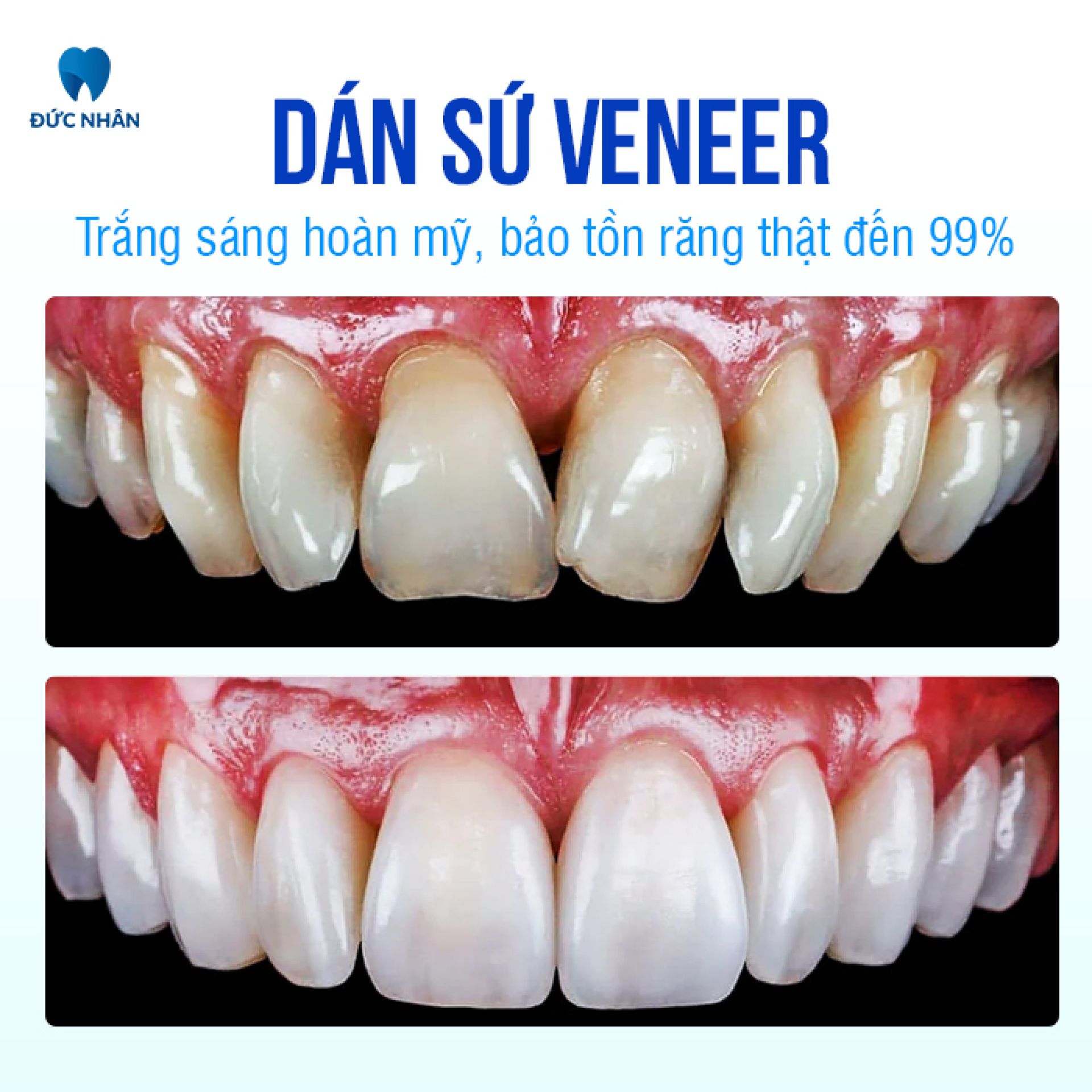 Dán sứ Veneer - Trắng sáng hoàn mỹ, bảo tồn răng thật đến 99%