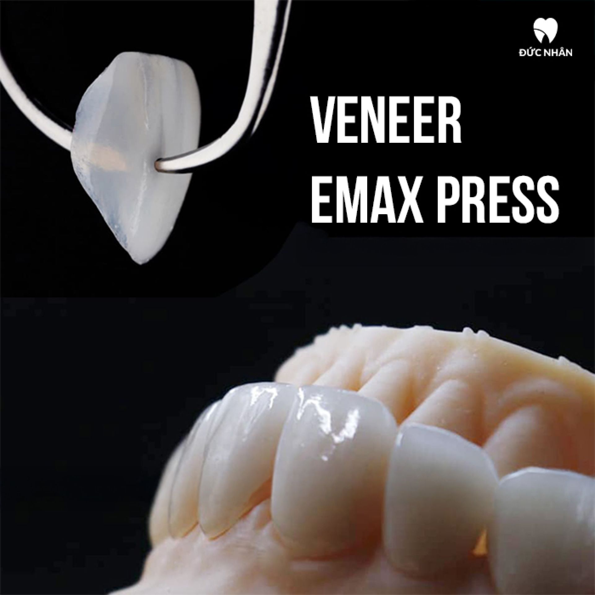 Veneer Emax Press - Đức